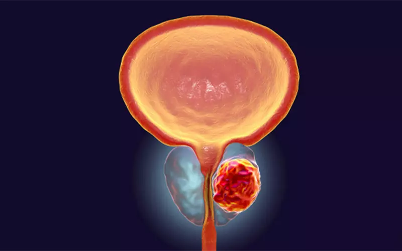 آنچه که باید در مورد سرطان پروستات بدانید